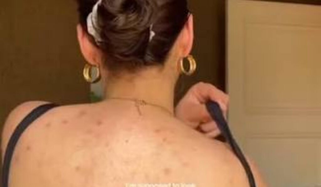Treat Back Acne