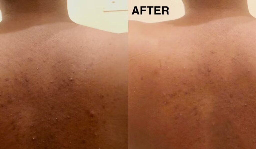 Treat Back Acne
