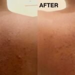 Treat Back Acne