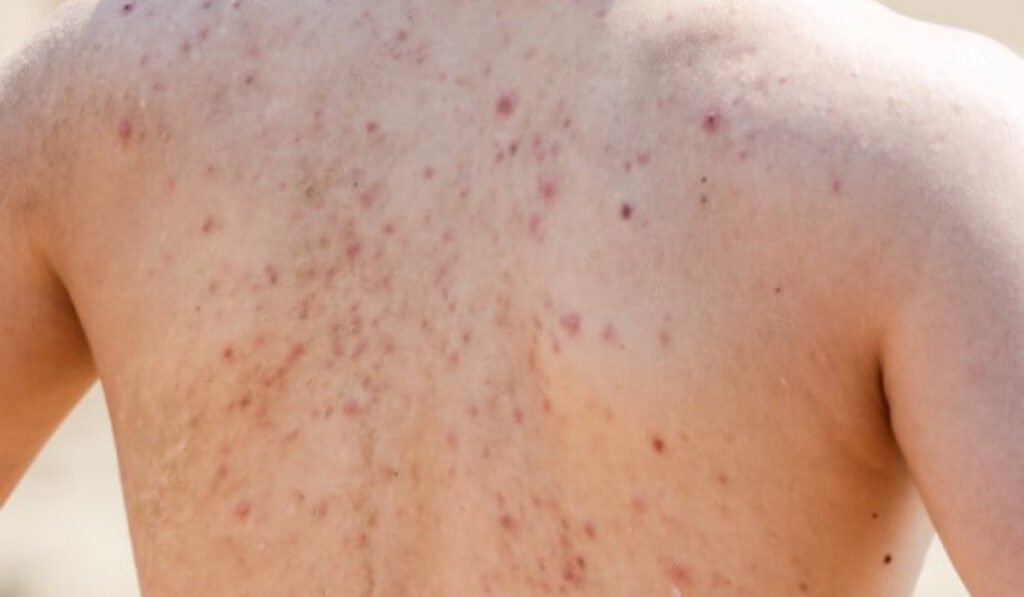 Treat Back Acne