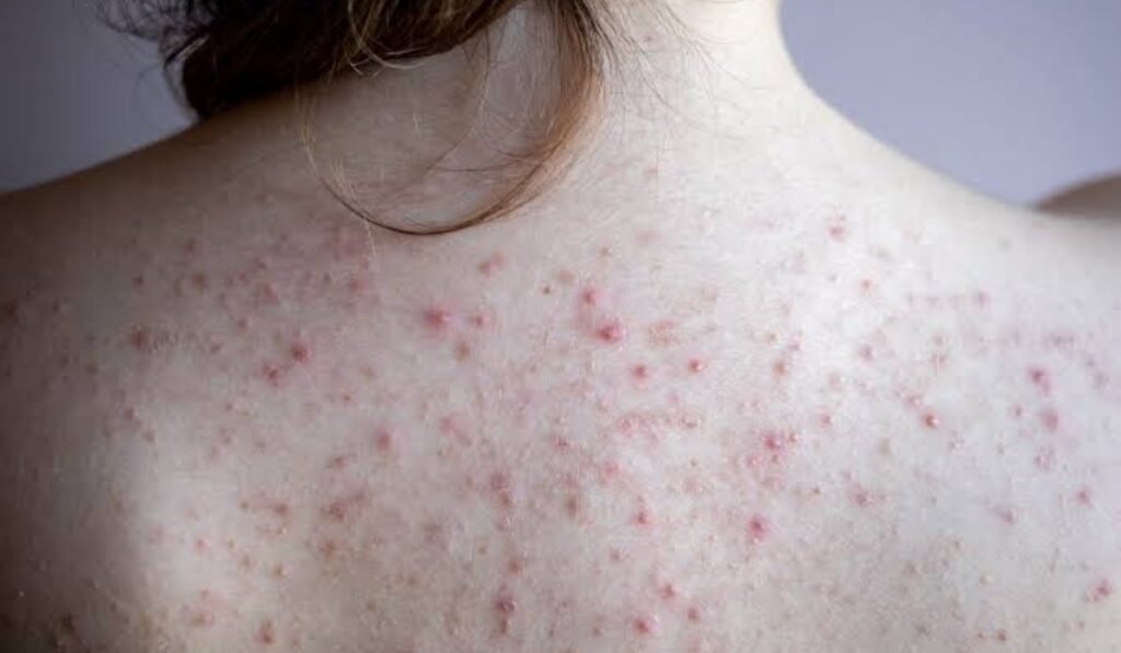Treat Back Acne