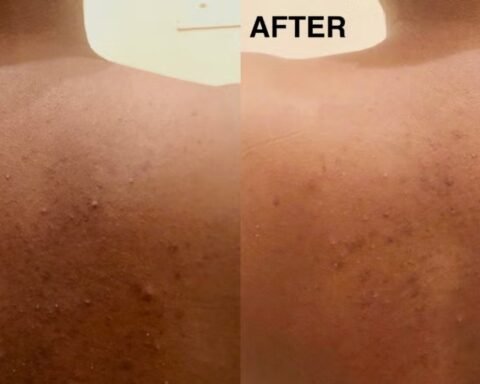 Treat Back Acne
