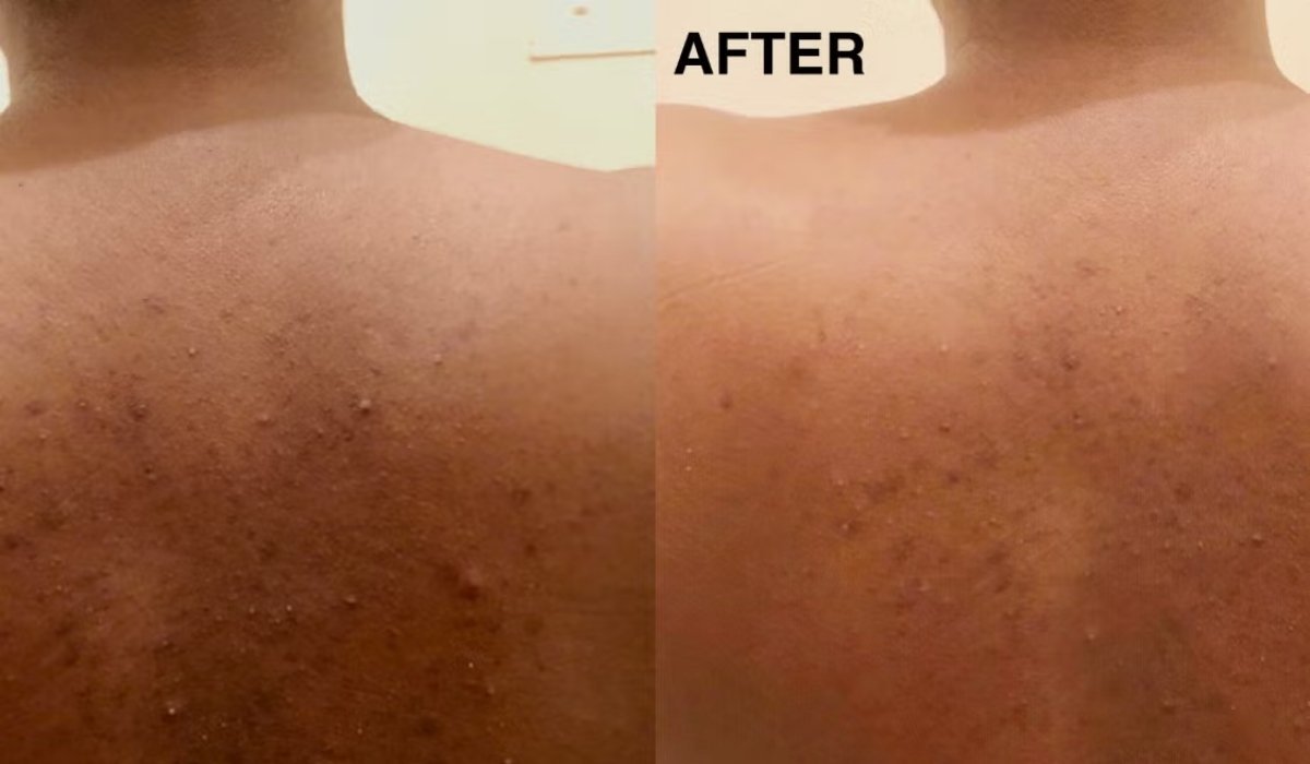 Treat Back Acne